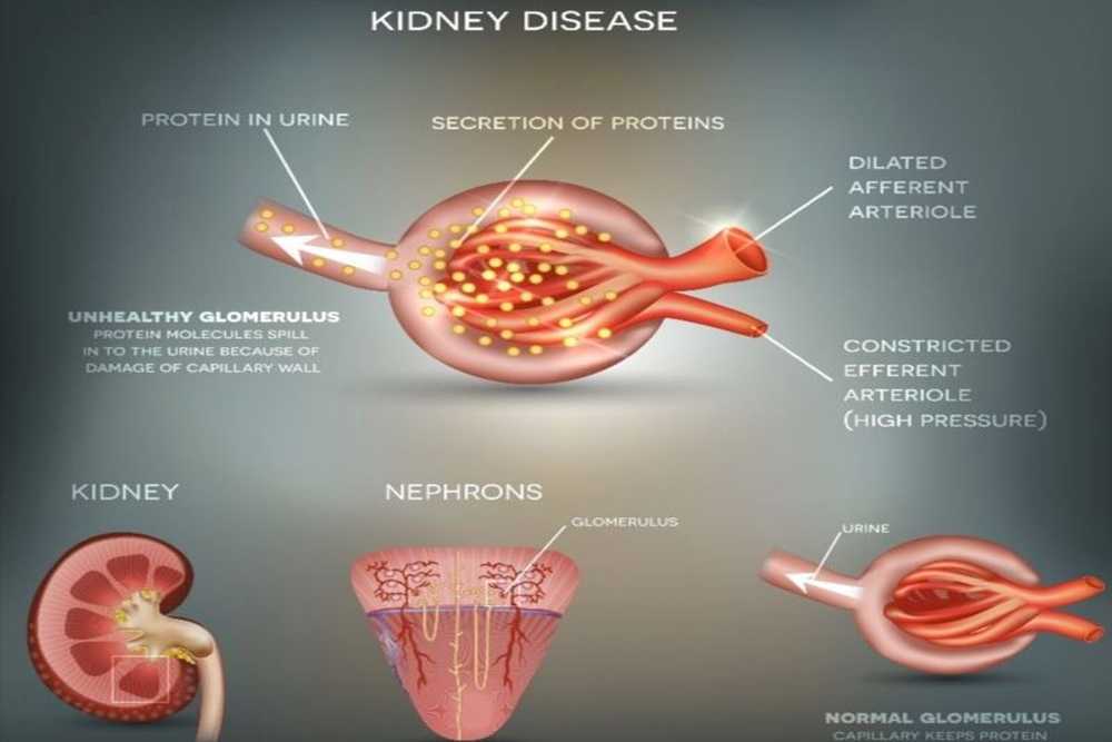 The Firefighter  — Diabetic Nephropathy, Proteinuria to Trace, Back on Active Duty