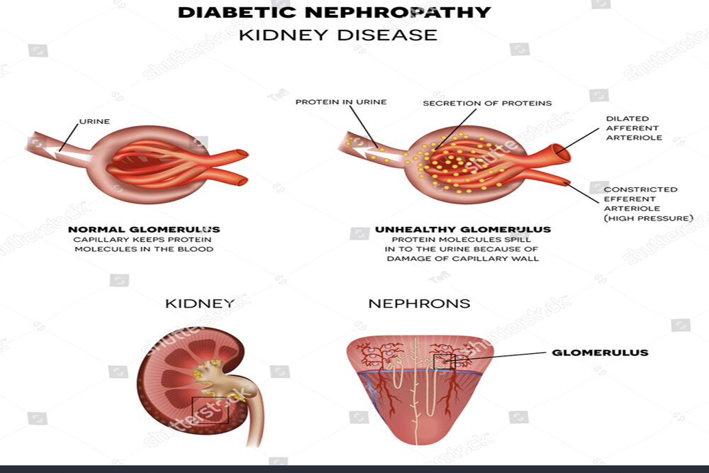 The Teacher  — Diabetic Nephropathy, Proteinuria from 3.5g to Under 1g